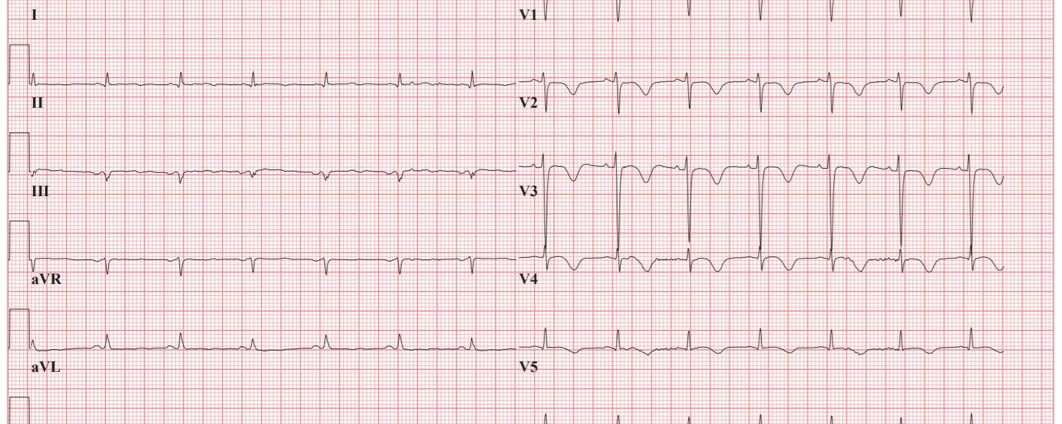 LAD arterie NSTEMI bij ischemische colitis met o.a. hypokaliëmie, hypoalbuminemie, bloedverlies per anum en systemische candidiasis
